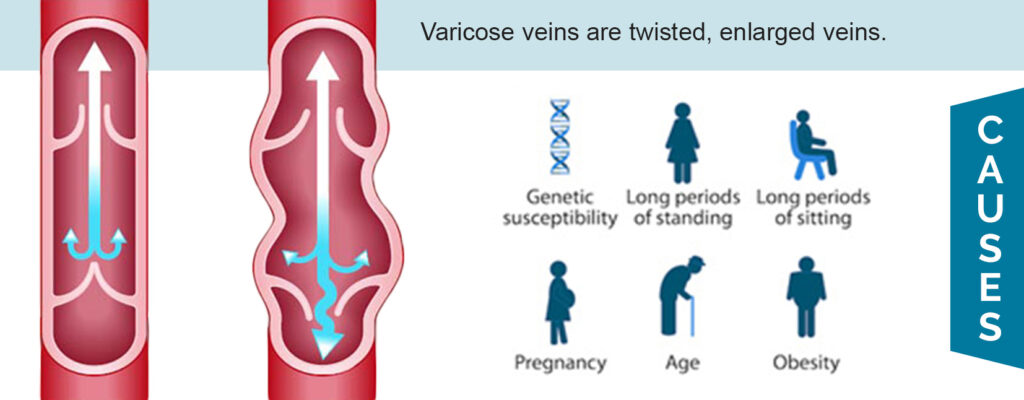 Causes of Varicose Veins - Star Magic Healing