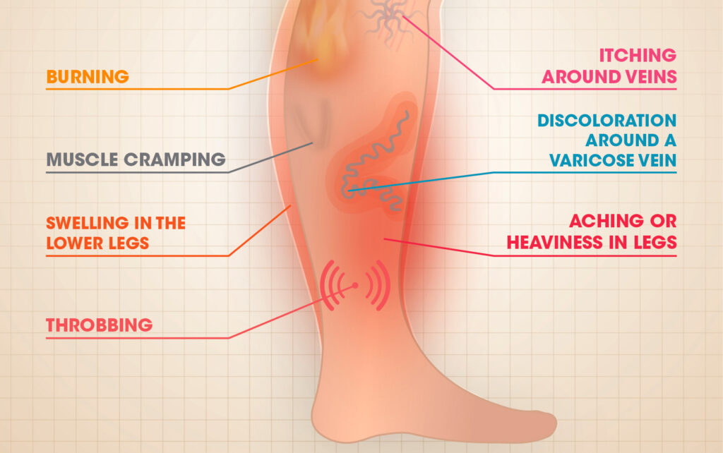 Symtoms  of Varicose Veins  - Star Magic Healing